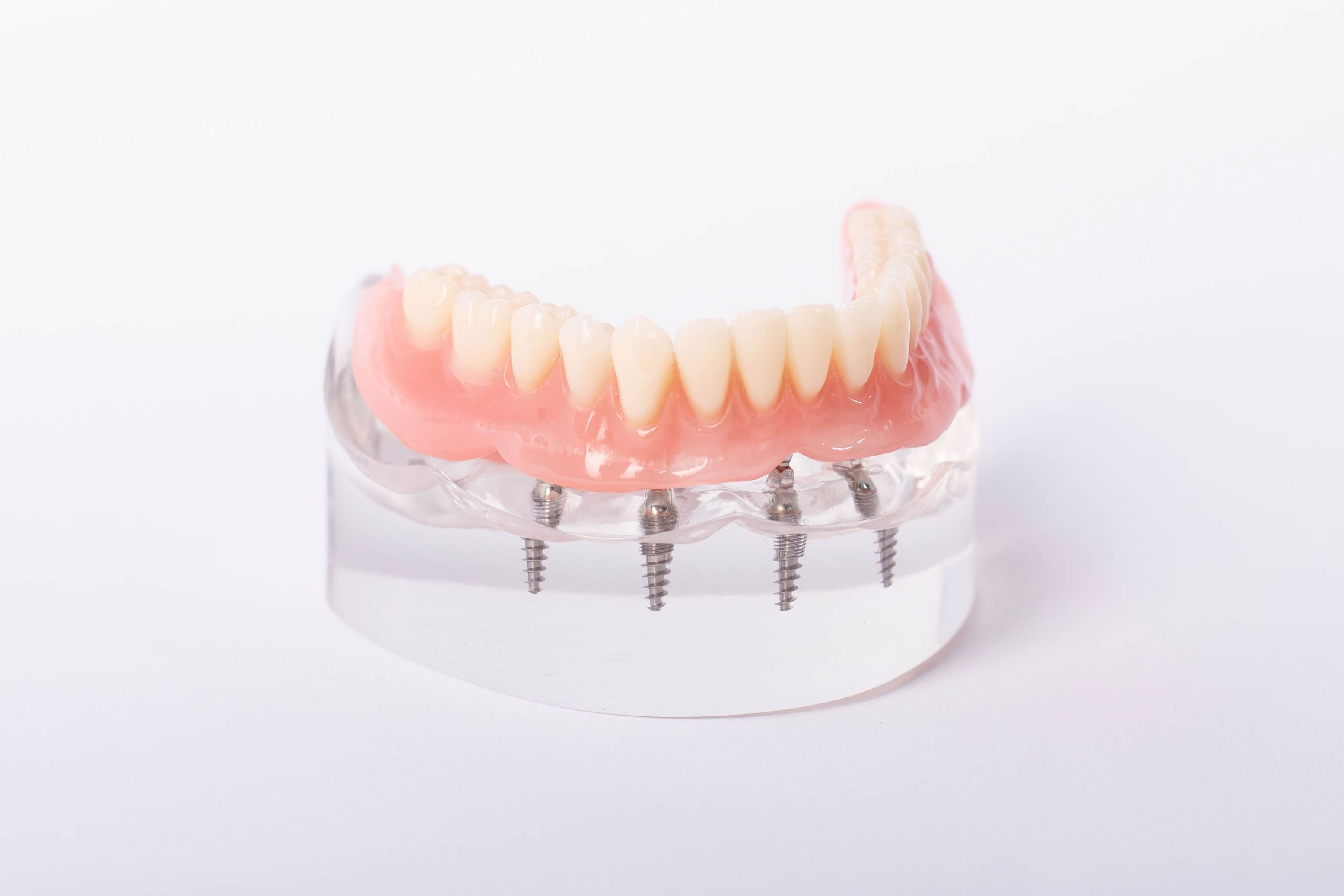 インプラントオーバーデンチャー（自費診療）