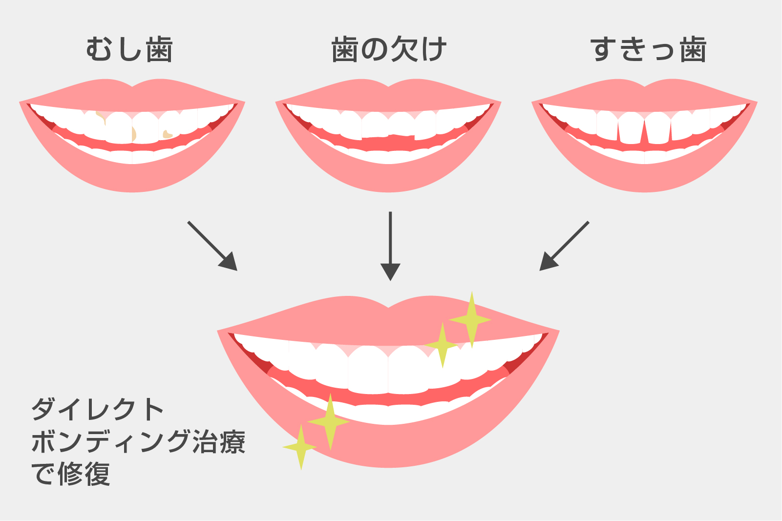 ダイレクトボンディングについて